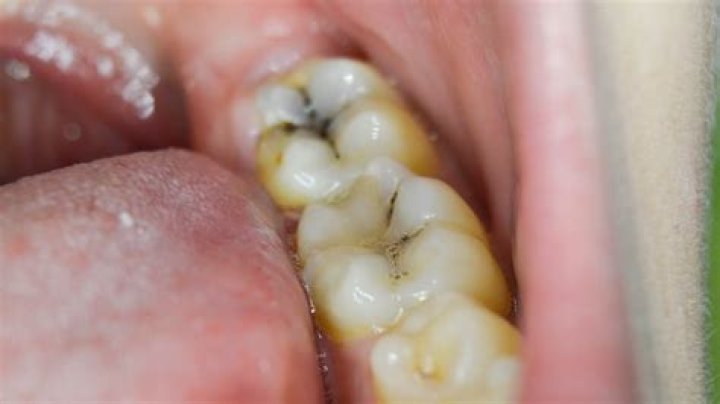 What does a hole in a tooth look like?